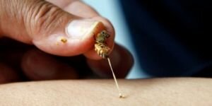 Kas hastalıkları arı zehriyle tedavi edilebilecek